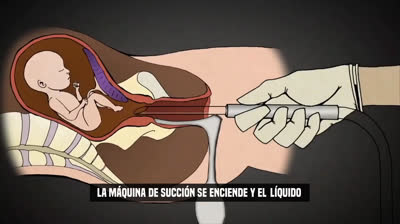 Esto es un aborto.