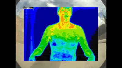 ETS Hyperhidrosis Surgery - The Surgery that RUINED my life - Sympathectomy #hyperhidrosis